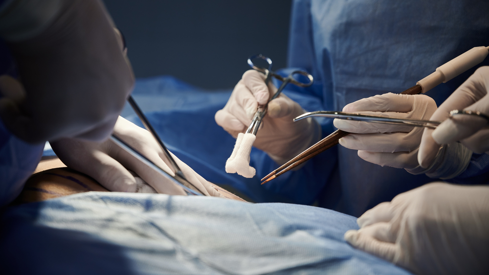 Common Surgical Errors and Their Impact